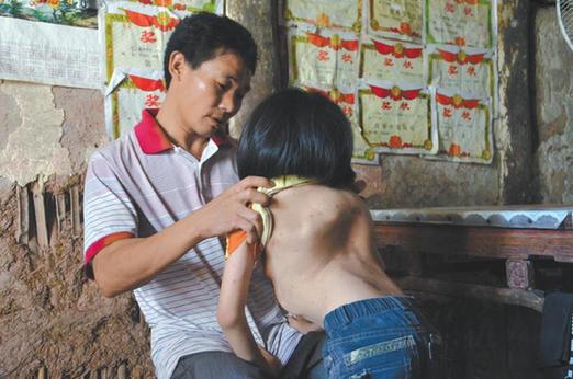 有嚴(yán)重脊椎畸形及胸腔隆突病的李文霞。