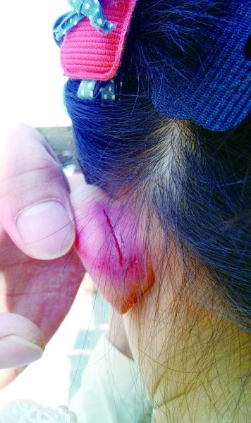 　　女童的耳朵被老師揪裂。圖片由女童家人提供
