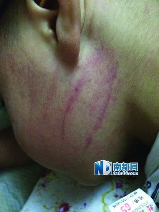 小逸臉上淤痕清晰可見。