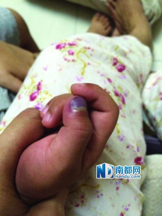 小逸手指被夾傷。