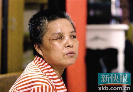 4月初,趙女士遭人搶劫并被打傷,現(xiàn)今右眼失明,頭部被縫100多針。記者 畢志毅/攝