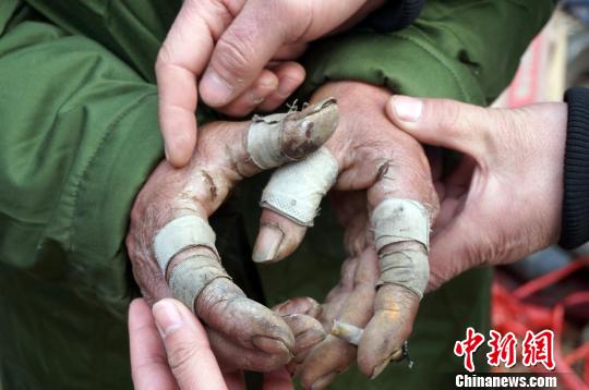 圖為由于常年拾荒，老人雙手布滿傷口。周小云 攝