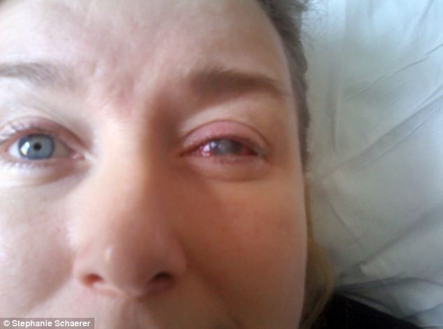恐怖慎入！隱形眼鏡致英女子摘除眼球