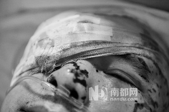 李建新頭部還有被潑硫酸的痕跡，醫(yī)生說被砍傷的右眼已經(jīng)失明。 南都記者 田飛 攝
