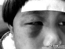 6月2日，網(wǎng)曝渭南市臨渭區(qū)一不滿5歲的女童遭奶奶毆打，眼圈青腫，引起網(wǎng)友關(guān)注，但孩子父母和爺爺均稱是摔倒導(dǎo)致。相關(guān)部門介入調(diào)查發(fā)現(xiàn)確為奶奶毆打所致，鑒于其身體原因已進(jìn)行批評(píng)教育。