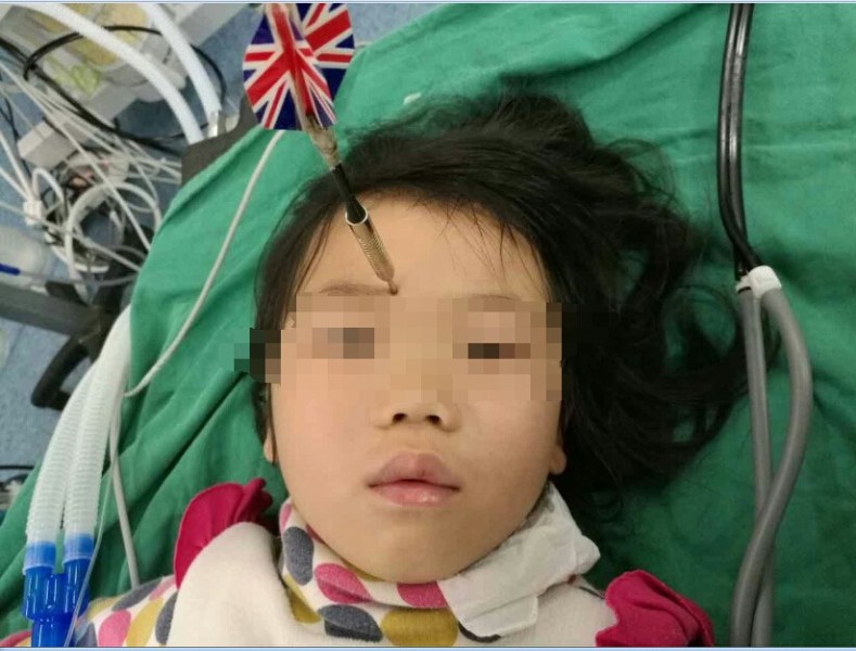 十多公分長的飛鏢穩(wěn)穩(wěn)地 ” 定 ” 在了一名六歲半的女童額頭上，小青一家人凌晨從長順趕到貴醫(yī)附院急診室時，看到如此慘烈的情況，接診醫(yī)生都嚇了一跳。詳細詢問下得知，原來是七歲的哥哥和六歲半的表妹在玩耍時，哥哥不慎將路邊撿來的真飛鏢扎到了妹妹的額頭上。
