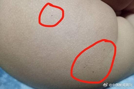 據(jù)多名紅黃藍(lán)(新天地分園)家長反映，孩子腿部、屁股、腋下出現(xiàn)針眼。