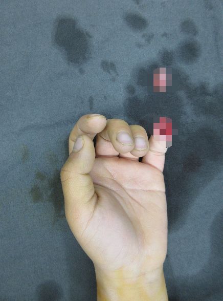 嚇哭！6歲男孩被夾斷手指 罪魁禍首竟是校服