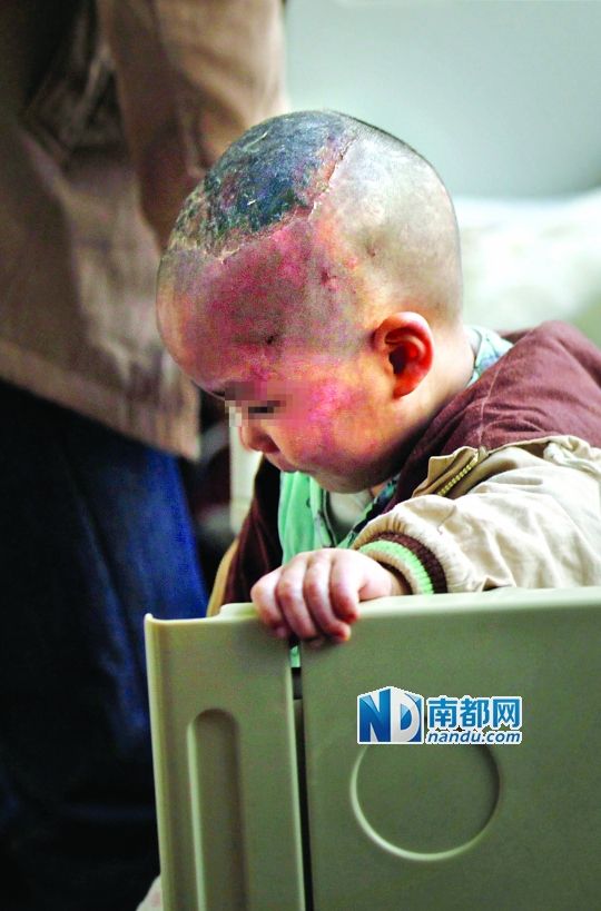 1月8日下午，小寶頭上和臉上都是傷痕。