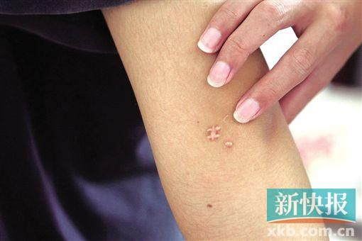 取出針后李星兒手臂留下了傷口。新快報(bào)記者 張國(guó)鋒/攝