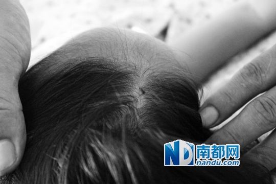女童頭上被扎的針孔（圓圈處）。賈先生說，被扎不到三秒鐘，女兒就昏了。
