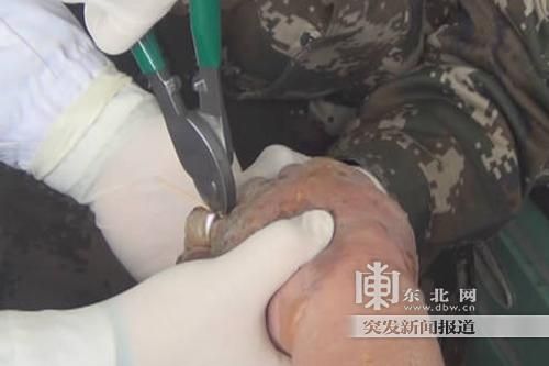 正在拆除戒指。