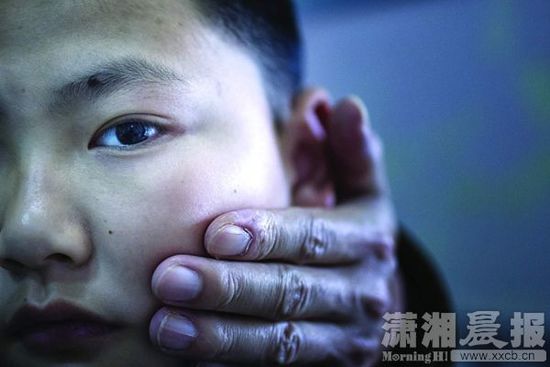 1月13日，小玨的父親心疼地摸著兒子的臉。