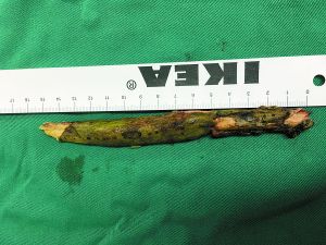 插入男子腦內(nèi)的樹枝。
